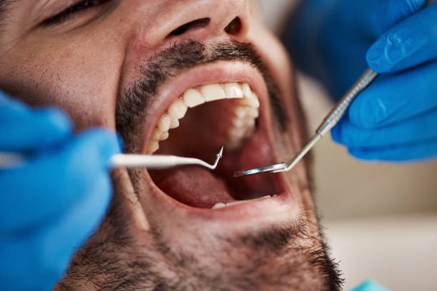 Best Dental Fillings (Composite and Amalgam)  in Severna Park, MD